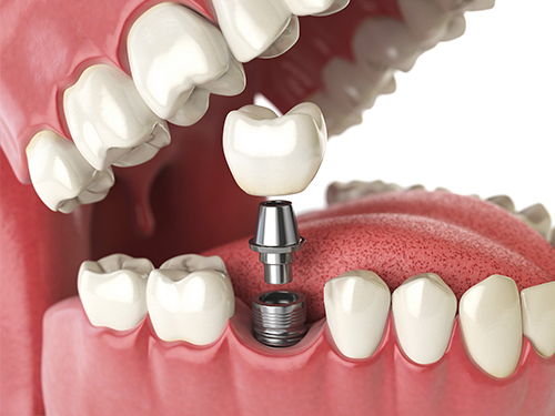 dental crowns bridges westville 