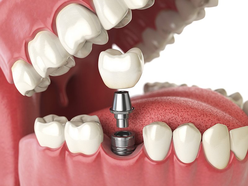dental crowns bridges westville