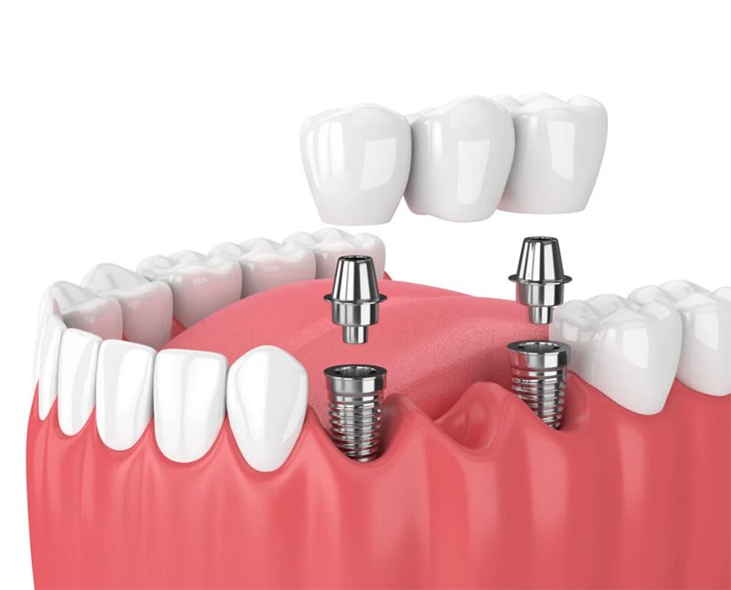 dental impants westville
