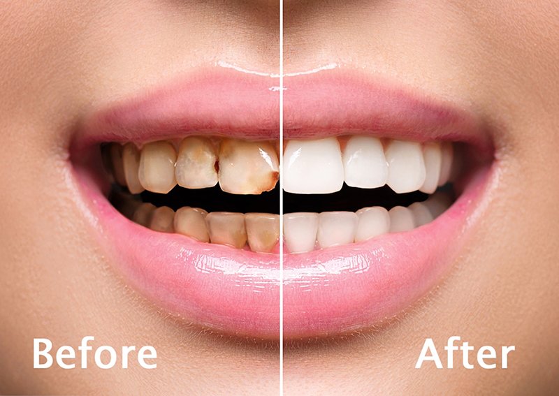 dental tooth cleaning westville