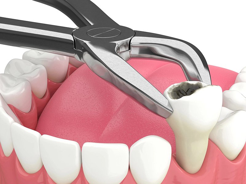 tooth extractions westville