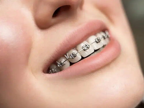 tooth braces westville
